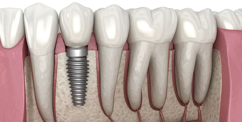 dental implant surgeon in chandigarh