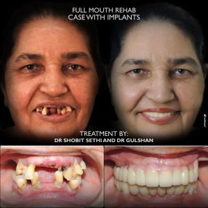 implant specialist in chandigarh