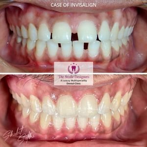 dental veneer specialist in chandigarh