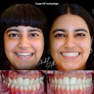 dental veneer specialist in chandigarh