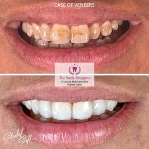 dental veneer specialist in chandigarh