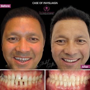 invisible braces in chandigarh