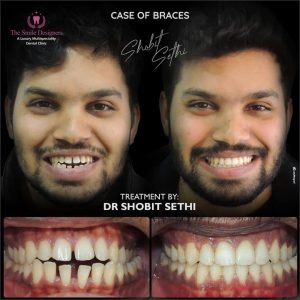 invisible braces in chandigarh