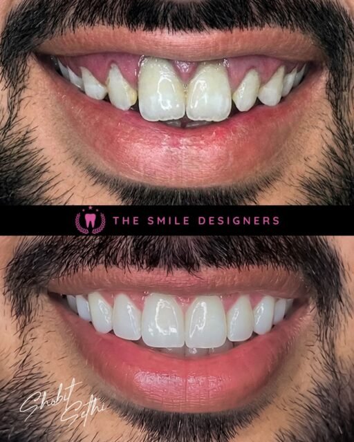 Before & After — See How Beautiful & Natural Her New Smile Looks 😍

The difference is incredible, but what makes this transformation special is how natural and beautifully balanced her new smile looks.

Every detail was carefully planned to complement her face, features, and personality — creating a smile that looks elegant, natural, and confident.

A beautiful smile should never look artificial. It should look like the best version of your own smile. ✨

See the before and after transformation by Dr. Shobit Sethi at The Smile Designers.

For a natural-looking smile makeover, choose the Best Dentist in Chandigarh and a Top Dentist in Chandigarh trusted for advanced cosmetic dentistry.

📍The Smile Designers
Mohali | Chandigarh

#BestDentistInChandigarh #TopDentistInChandigarh #DrShobitSethi #BeforeAfterSmile #SmileTransformation