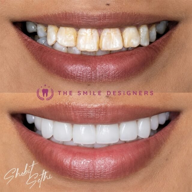 See the difference veneers can make! From her before smile to her beautiful after smile, the transformation is clear.

It’s not just about changing teeth — it’s about creating a smile that looks natural, balanced, and gives you a whole new level of confidence. ❤️

Every detail was carefully planned and crafted by Dr. Shobit Sethi at The Smile Designers.

If you’re looking for the Best Dentist in Chandigarh for veneers or a Top Dentist in Chandigarh for a complete smile makeover, see what a carefully designed smile can do.

📍The Smile Designers, Mohali | Chandigarh

#BestDentistInChandigarh #TopDentistInChandigarh #DrShobitSethi #TheSmileDesigners #BeforeAfterVeneers