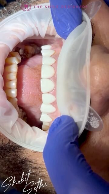 It’s not just about placing veneers — it’s about precision, fit, symmetry, and every tiny detail.

Watch Dr. Shobit Sethi carefully install each veneer and see how every tooth is positioned to create a beautifully balanced, natural-looking smile.

From the first placement to the final result, the precision can be seen in every step. 🦷✨

The final smile? Clean. Natural. Confident. Beautiful.

For veneers and smile makeovers, choose the Best Dentist in Chandigarh and consult a Top Dentist in Chandigarh at The Smile Designers.

📍The Smile Designers, Mohali | Chandigarh

#BestDentistInChandigarh #TopDentistInChandigarh #DrShobitSethi #TheSmileDesigners #DentalVeneers VeneerInstallation