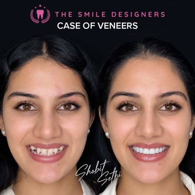 Look at this incredible veneer transformation! ✨
From the before smile to the final result, the difference is truly beautiful.
Veneers are not just about making teeth brighter — they are about creating the right shape, proportion, symmetry, and harmony for each individual smile.
A beautiful smile can make a powerful difference in both appearance and confidence — for men and women alike.
See the before. See the after. See the transformation created by Dr. Shobit Sethi at The Smile Designers.
Looking for the Best Dentist in Chandigarh or a Top Dentist in Chandigarh for your smile makeover?
📍The Smile Designers | Mohali • Chandigarh
#BestDentistInChandigarh #TopDentistInChandigarh #DrShobitSethi #TheSmileDesigners #DentalVeneers