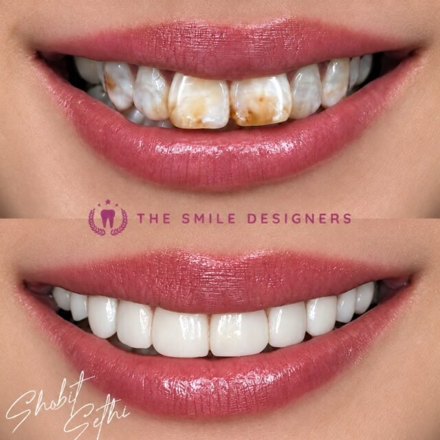 See the difference in this stunning before-and-after transformation by Dr. Shobit Sethi. ✨
From the original smile to a beautifully balanced, natural-looking new smile, every detail was carefully planned to complement her facial features and overall appearance.
The result? A brighter smile, better harmony, and a whole new level of confidence. ❤️
If you’re considering veneers, choose the Best Dentist in Chandigarh for personalized smile design and consult a Top Dentist in Chandigarh at The Smile Designers.
📍 The Smile Designers | Mohali • Chandigarh
#BestDentistInChandigarh #TopDentistInChandigarh #DrShobitSethi #TheSmileDesigners #BeforeAfter