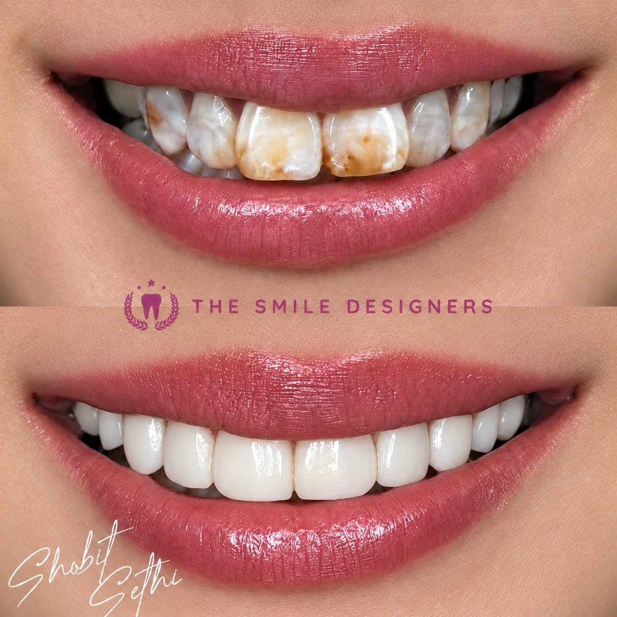 See the difference in this stunning before-and-after transformation by Dr. Shobit Sethi. ✨
From the original smile to a beautifully balanced, natural-looking new smile, every detail was carefully planned to complement her facial features and overall appearance.
The result? A brighter smile, better harmony, and a whole new level of confidence. ❤️
If you’re considering veneers, choose the Best Dentist in Chandigarh for personalized smile design and consult a Top Dentist in Chandigarh at The Smile Designers.
📍 The Smile Designers | Mohali • Chandigarh
#BestDentistInChandigarh #TopDentistInChandigarh #DrShobitSethi #TheSmileDesigners #BeforeAfter