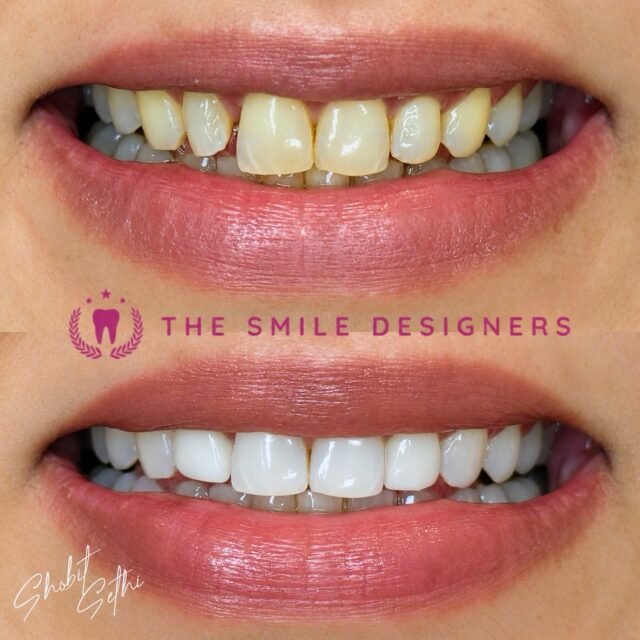 Before & After – See the Veneer Transformation by Dr. Shobit Sethi! 😁
A beautiful smile is all about the right shape, balance, and natural-looking results.
See the difference in this before-and-after veneer transformation by Dr. Shobit Sethi. Every detail matters when designing a smile that complements the patient’s facial features and creates a confident new look.
It’s not just about whiter teeth — it’s about a smile that feels right and looks beautiful. ✨
Looking for the Best Dentist in Chandigarh or a Top Dentist in Chandigarh for your smile makeover? Visit The Smile Designers to explore your options.
📍 The Smile Designers
Mohali | Chandigarh
#BestDentistInChandigarh #TopDentistInChandigarh #DrShobitSethi #TheSmileDesigners #DentalVeneer