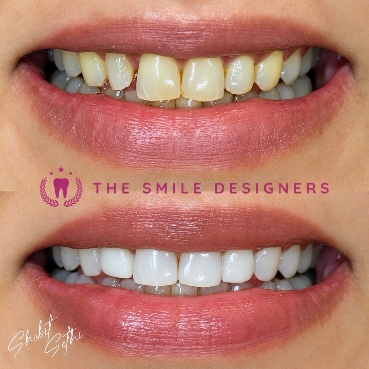 Before & After – See the Veneer Transformation by Dr. Shobit Sethi! 😁
A beautiful smile is all about the right shape, balance, and natural-looking results.
See the difference in this before-and-after veneer transformation by Dr. Shobit Sethi. Every detail matters when designing a smile that complements the patient’s facial features and creates a confident new look.
It’s not just about whiter teeth — it’s about a smile that feels right and looks beautiful. ✨
Looking for the Best Dentist in Chandigarh or a Top Dentist in Chandigarh for your smile makeover? Visit The Smile Designers to explore your options.
📍 The Smile Designers
Mohali | Chandigarh
#BestDentistInChandigarh #TopDentistInChandigarh #DrShobitSethi #TheSmileDesigners #DentalVeneer