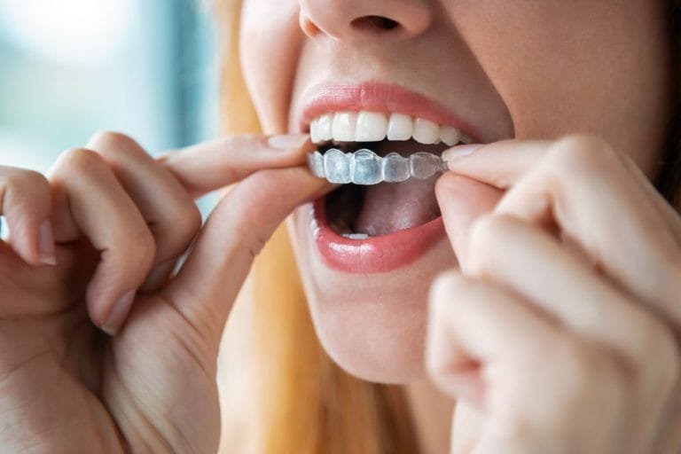 invisalign provider in chandigarh