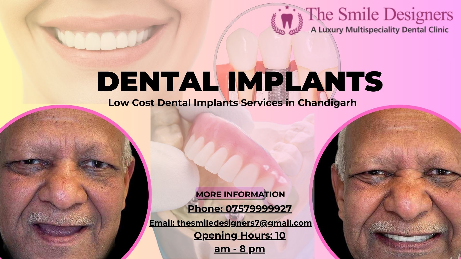 Dental Implants: "Trusted Care For Transforming Smile"