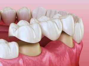 Bridging the Gap: Essential Tips for Dental Bridge Care