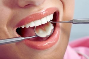 Safeguarding Your Smile: A Guide to Dental Fillings