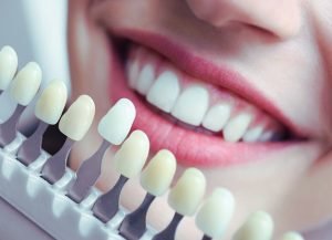 Understanding Dental Laminates: What Are They and How Do They Work?