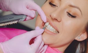 The Lifespan of Dental Veneers : How Long Do They Last?