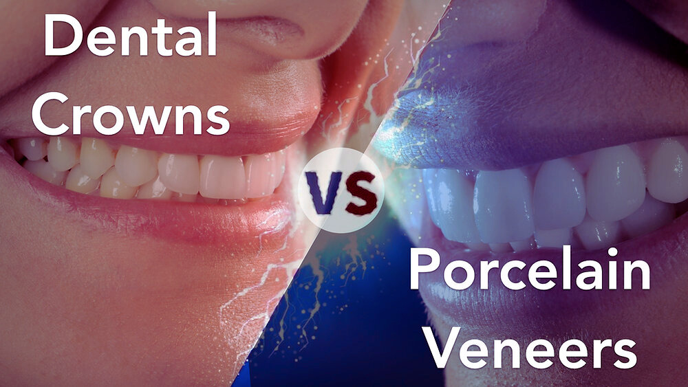 Dental Veneers vs. Dental Crowns