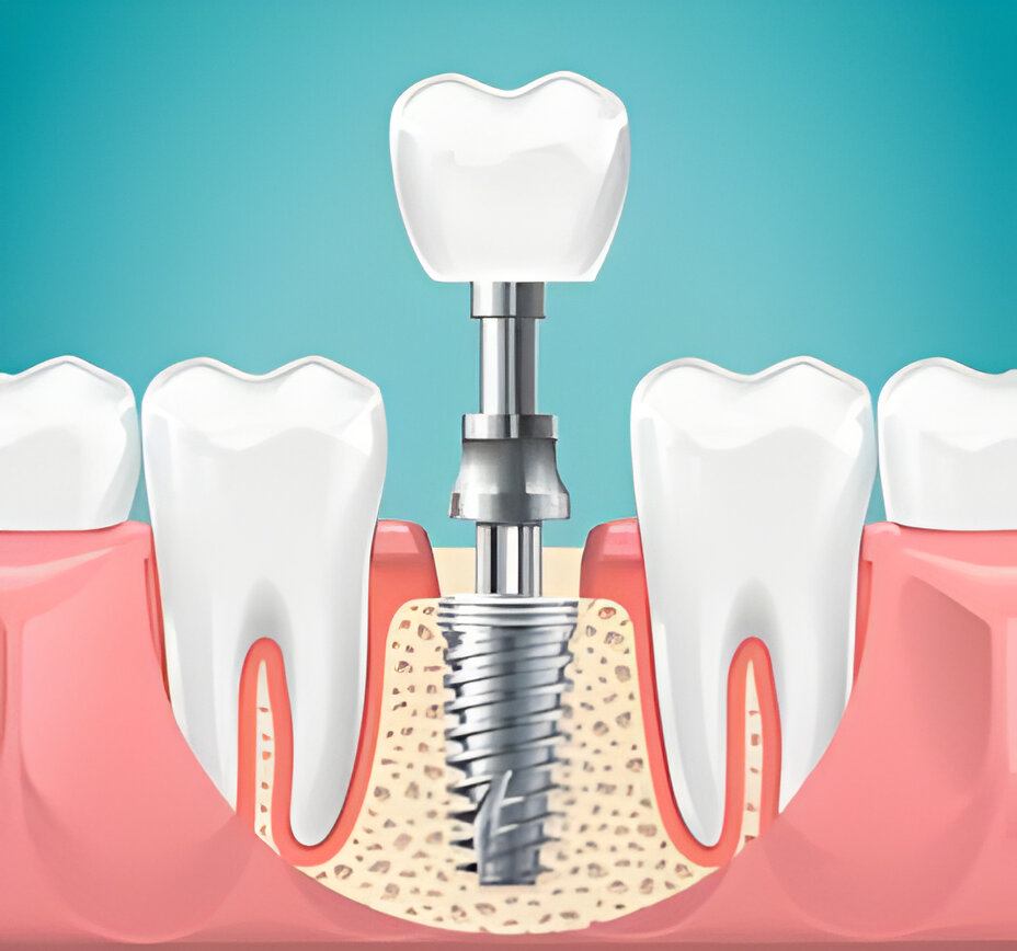 dental implant doctor in chandigarh