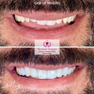 Veeners - best dentist in mohali