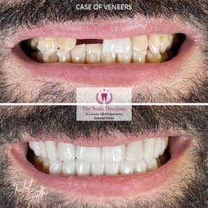 Veeners - best dentist in mohali