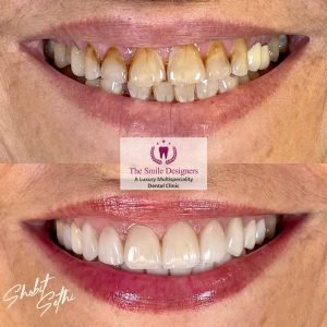 Veeners - best dentist in mohali