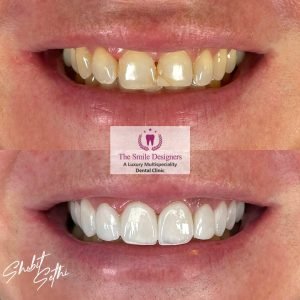 Veeners - best dentist in mohali