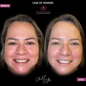 Veeners - best dentist in mohali
