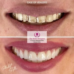 Veeners - best dentist in mohali