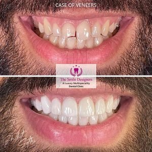 Veeners - best dentist in mohali