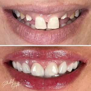 Veeners - best dentist in mohali