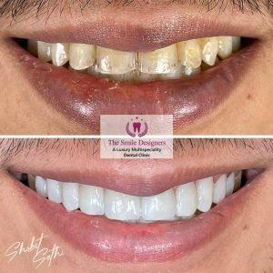 Veeners - best dentist in mohali