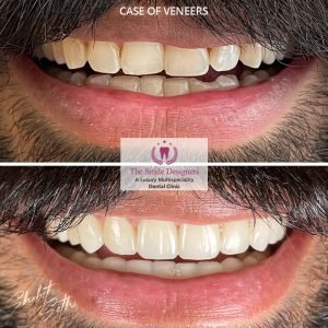 Veeners - best dentist in mohali