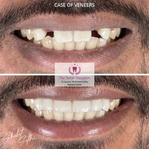 Veeners - best dentist in mohali
