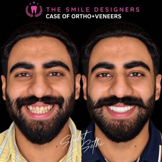 This stunning before-and-after transformation combines Invisalign teeth alignment and custom veneers, planned and completed by Dr. Shobit Sethi to create a balanced, beautiful, and confident smile.
First, the teeth were aligned with Invisalign. Then, veneers enhanced the shape, symmetry, and overall appearance of the smile. Every step was carefully planned to achieve a result that complements the patient’s facial features.
This is what happens when advanced orthodontics meets the art of cosmetic dentistry. ❤️
Looking for the Best Dentist in Chandigarh or a Top Dentist in Chandigarh for Invisalign and veneers? Discover personalized smile makeovers at The Smile Designers.
📍 The Smile Designers Mohali | Chandigarh
#BestDentistInChandigarh #TopDentistInChandigarh #DrShobitSethi #TheSmileDesigners #Invisalign