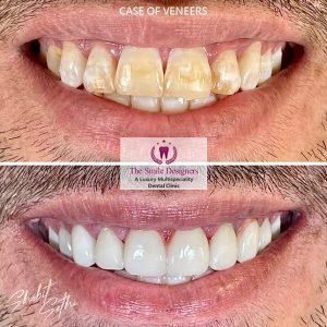 Veeners - best dentist in mohali