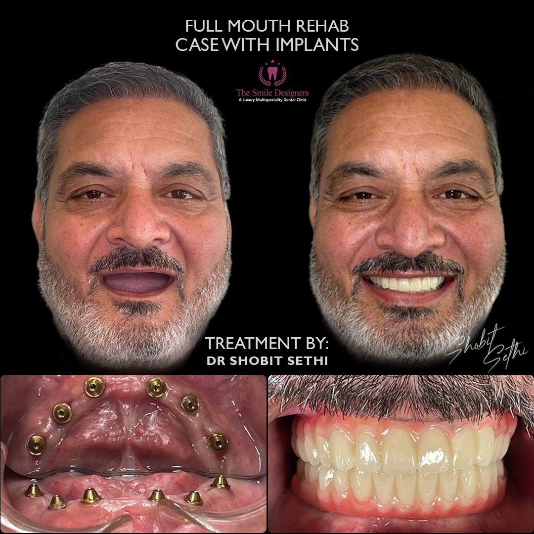 dental implant doctor in chandigarh