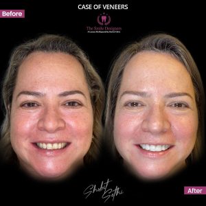 The Smile Designers -veneers