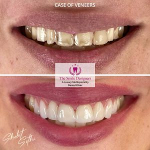 The Smile Designers -veneers