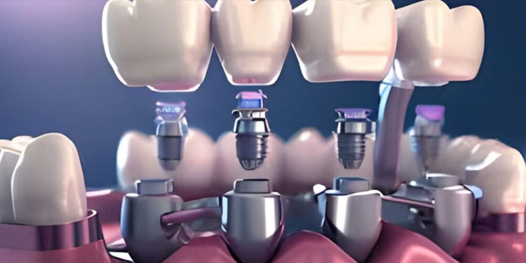 dental implant doctor in chandigarh
