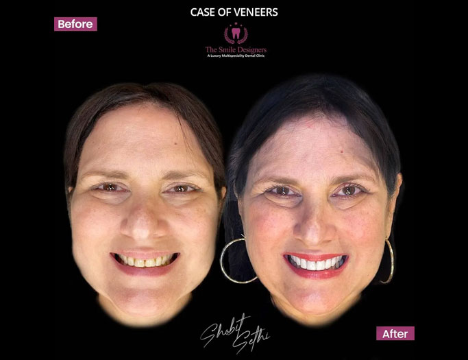 Dental Veneers and Laminates in Chandigarh