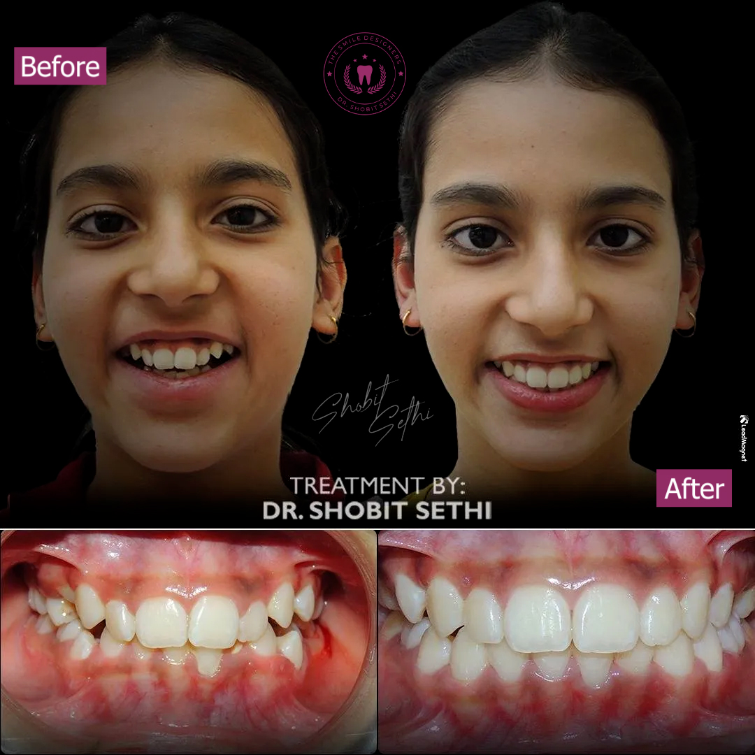 Invisilign Case - Best Dentist in mohali