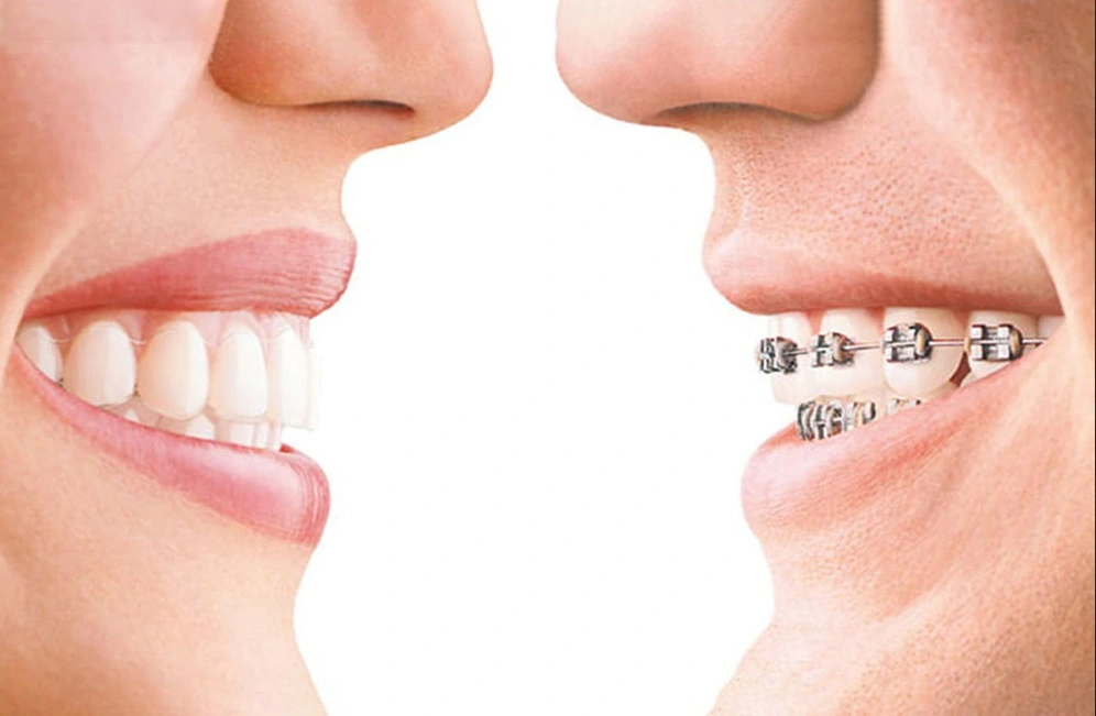 Invisalign vs. Traditional Braces