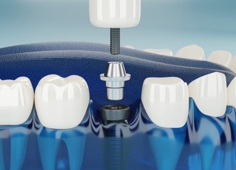 Dental implant in Chandigarh