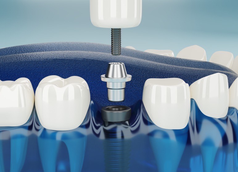 Dental implant in Chandigarh