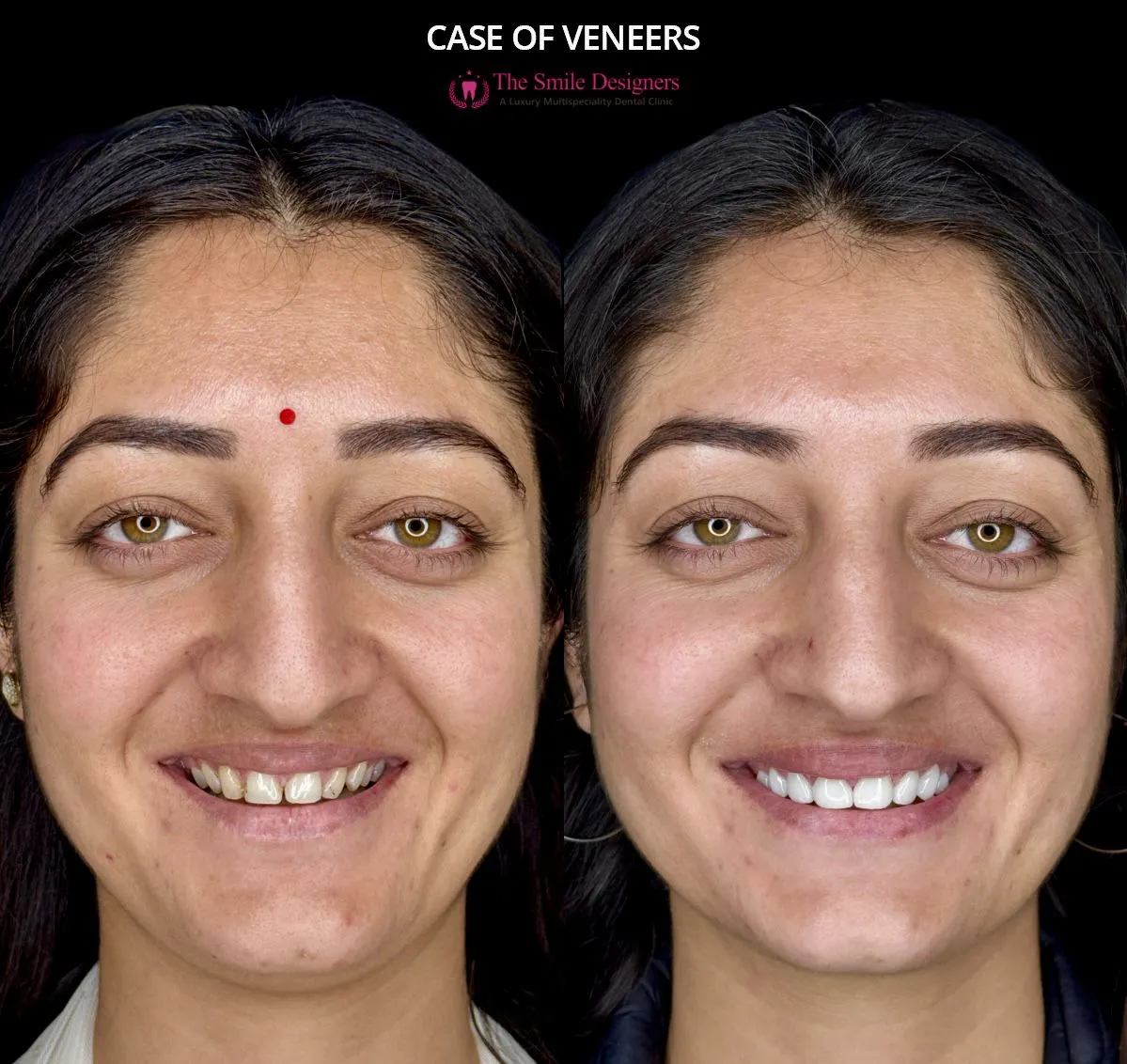 Veneers Before and After Photos - The Smile Designers - Best Dentist in Mohai Chandigarh