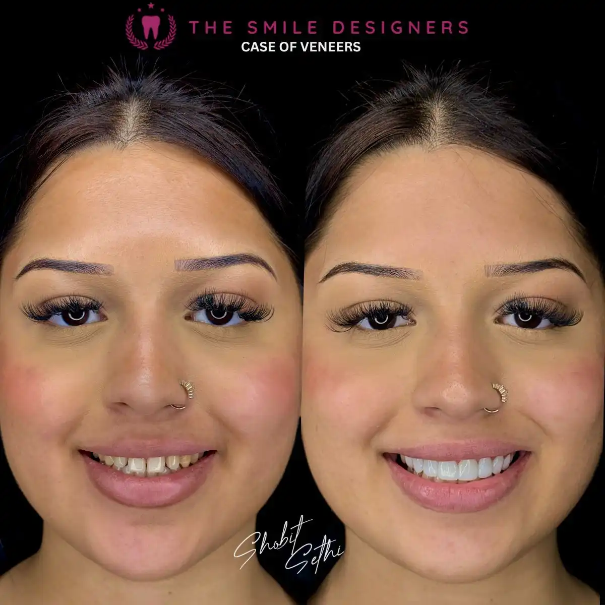 Veneers Before After Pics- The Smile Designers - Best Dentist In Chandigarh
