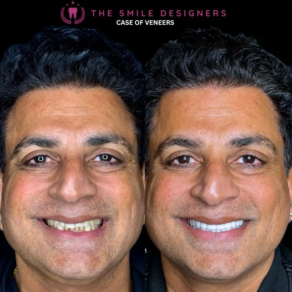 Veneers Before After Pics - The Smile Designers - Best Dentist In Chandigarh
