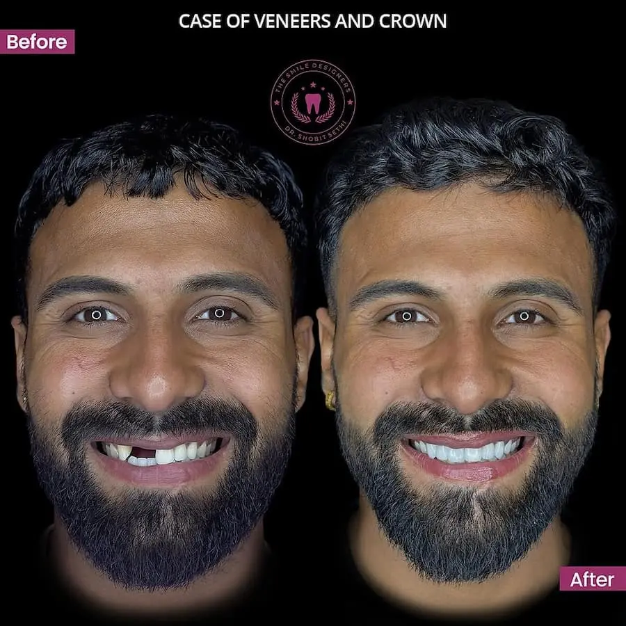 Best Dentist in Chandigarh Mohali Before-After-Crown-Patient-Photos - The Smile Designers