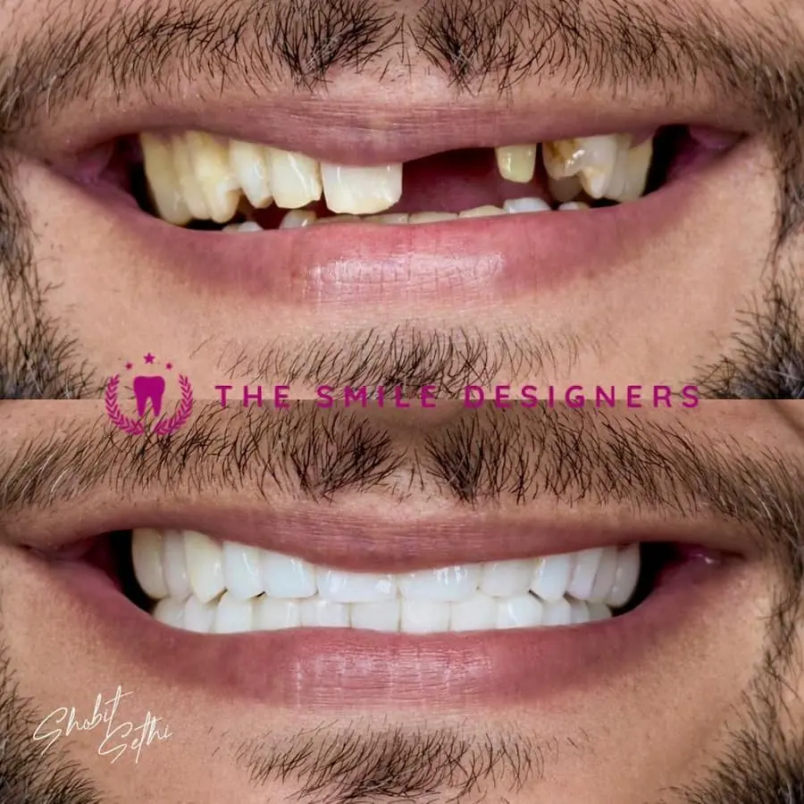 Best Dentist in Chandigarh Mohali Before-After-Crown-Venners-Patient-Photos - The Smile Designers